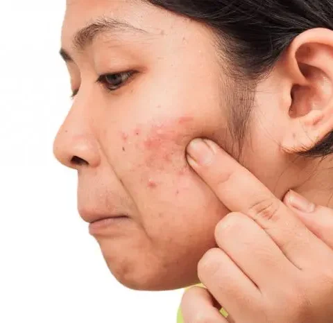 Oily Skin and Acne Solution Bundle (Pack of 2)