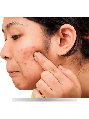 Oily Skin and Acne Solution Bundle (Pack of 2)