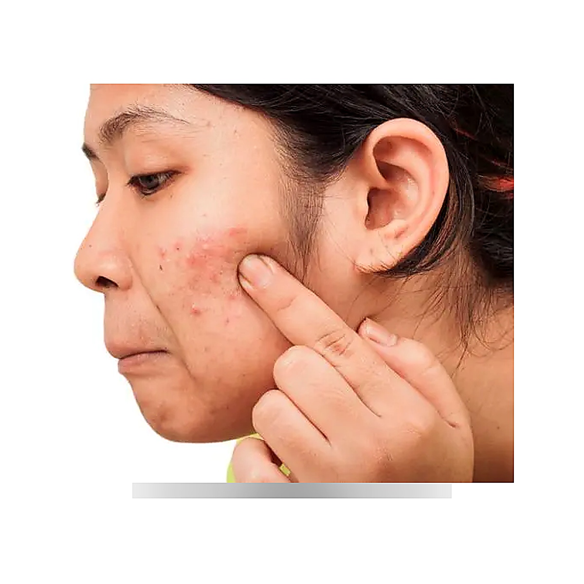 Oily Skin and Acne Solution Bundle (Pack of 2)